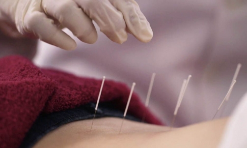 Acupuntura: un Tratamiento Antiguo para Problemas Modernos