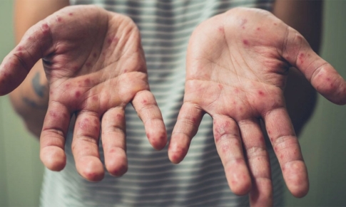 Dishidrosis (o Eccema Dishidrótico) y Aceites Esenciales